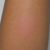 Close-up of a person's leg with a red rash on a plain background