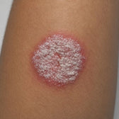 Wart on a person's leg with a white, elevated center and red edges.
