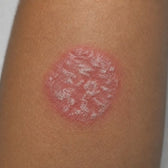 Close-up of a skin condition on a person's leg