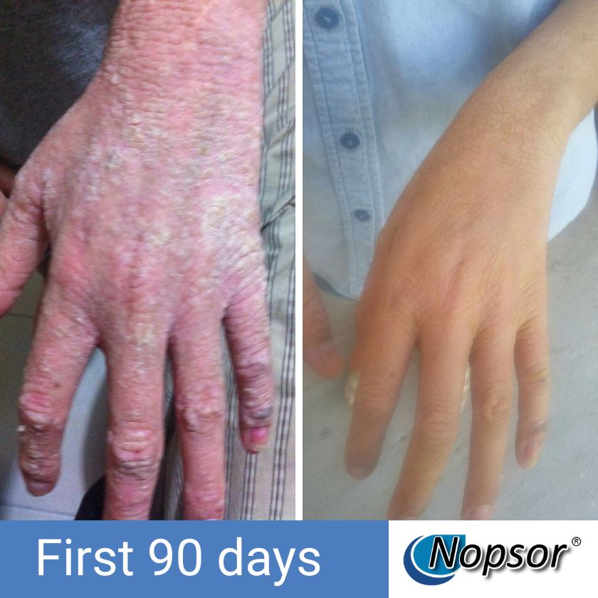 Before and after comparison of a hand with Nopsor treatment showing improvement over 90 days.