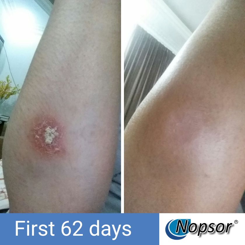 Before and after comparison of a skin condition on a leg with Nopsor branding.