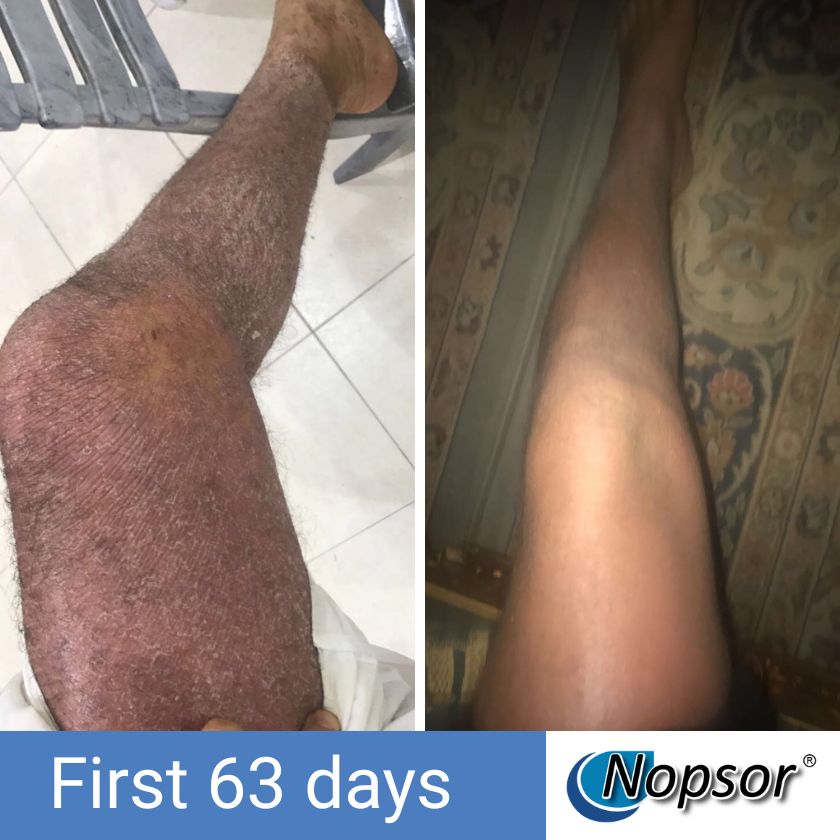 Before and after comparison of a leg with Nopsor treatment showing hair removal progress.