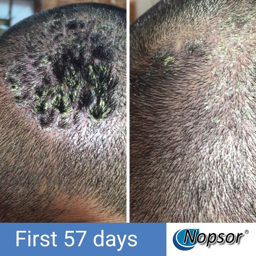Before and after comparison of scalp treatment with Nopsor logo