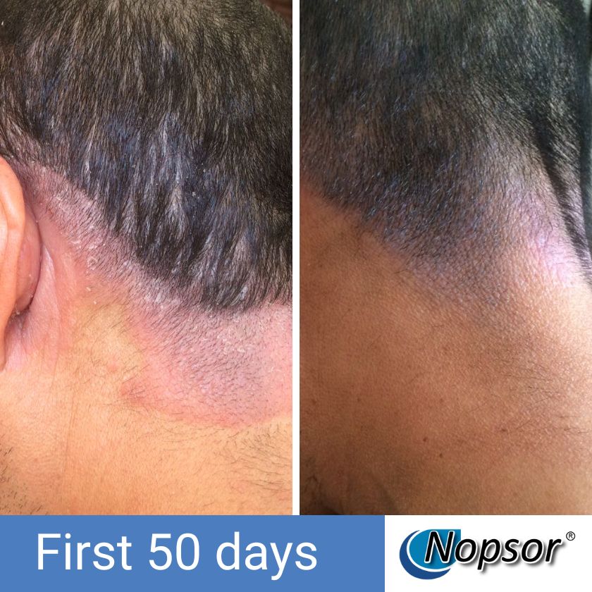 Before and after comparison of hair growth on a person's scalp with Nopsor branding.