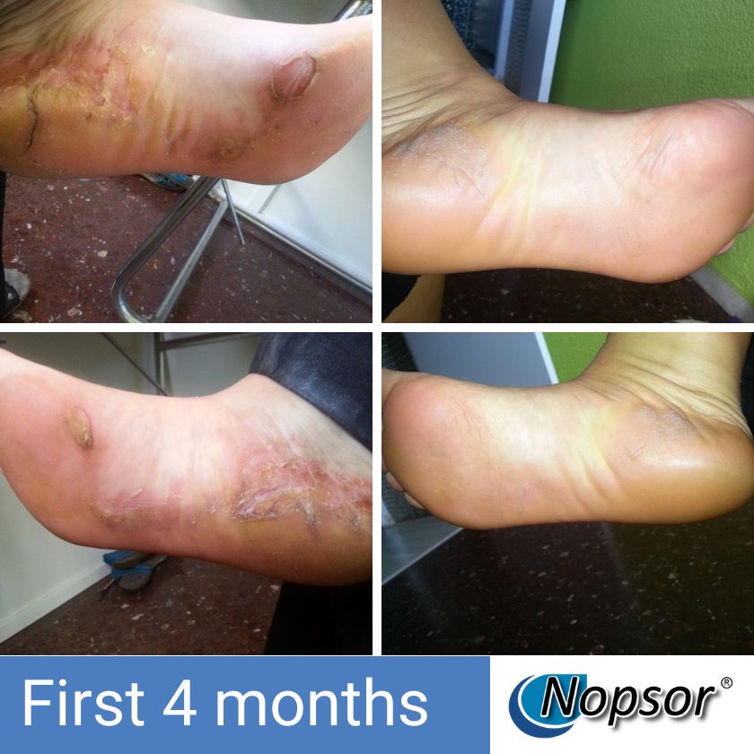 Collage of a foot with scarring and skin condition improvement over four months, featuring Nopsor branding.