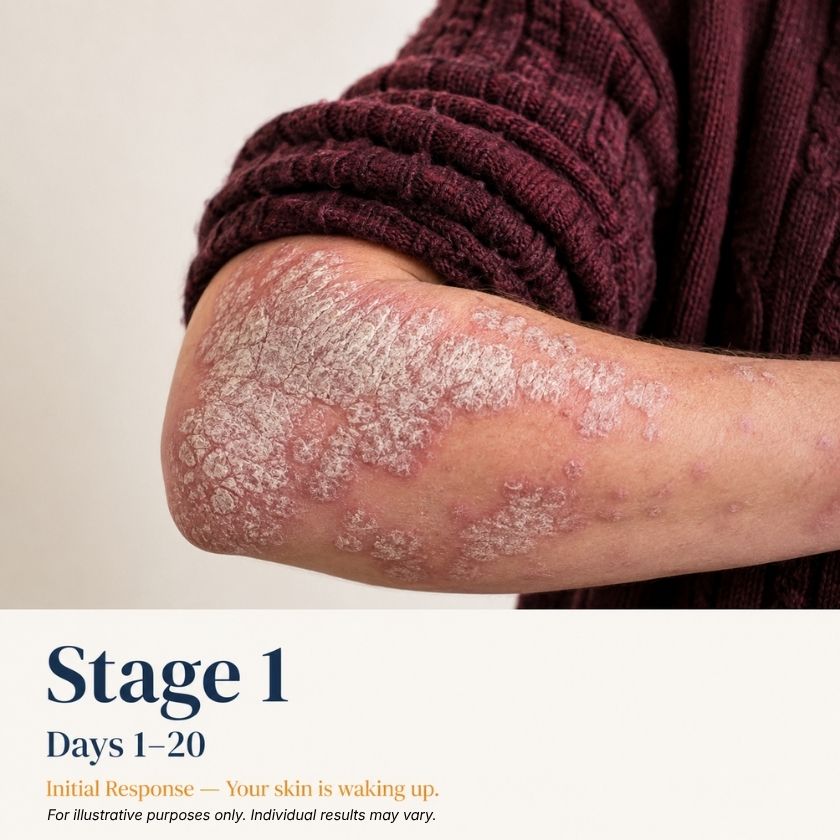 Illustration of a skin condition on an arm with text indicating 'Stage 1' and 'Day 1-20'.