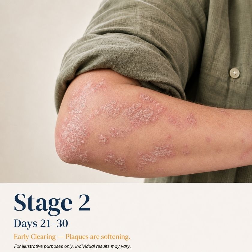 Person with a red mark on their arm, labeled 'Stage 2' and 'Day 21-30', on a blue background.