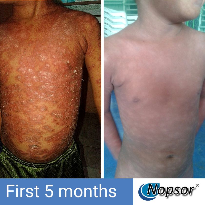 Before and after comparison of a person's skin condition treated with Nopsor over the first 5 months.
