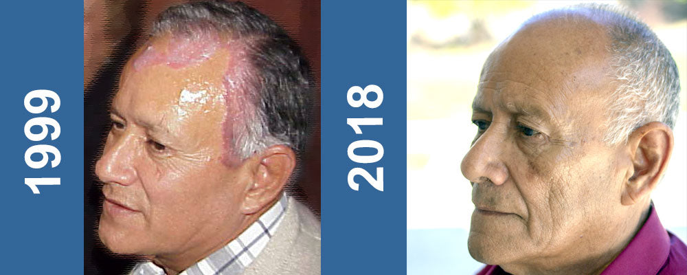 fotografía de antes y después del fundador con psoriasis y sin psoriasis Nopsor